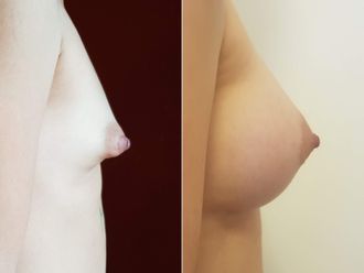 Aumento mamas antes y después - 880068