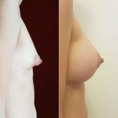 Aumento mamario en mama tuberosa - Bioestética Group