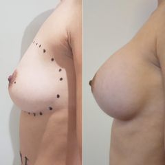 Aumento mamario - Bioestética Group