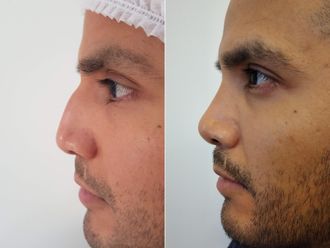 Rinoplastia antes y después - 880073