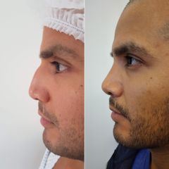 Rinoplastia - Bioestética Group
