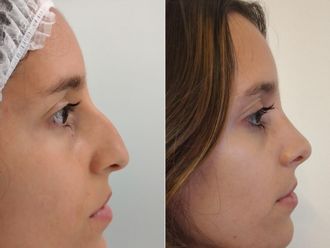 Rinoplastia antes y después - 880074