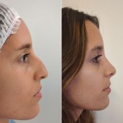 Rinoplastia - Bioestética Group