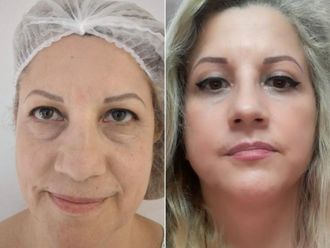 Lifting antes y después - 880075