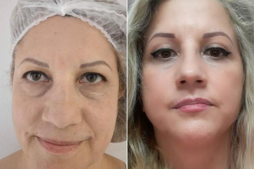 Lifting antes y después - 880075