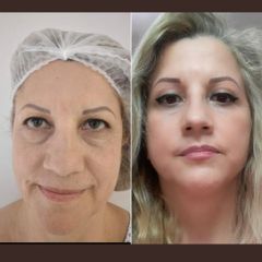 Lifting facial con blefaroplastia - Bioestética Group