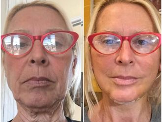 Lifting antes y después - 880076