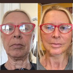 Lifting facial con implante de mentón - Bioestética Group