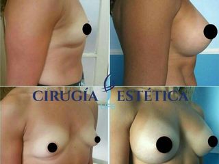 Aumento mamario 400cc