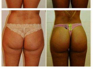 Lipotransferencia glutea con hilo tensor