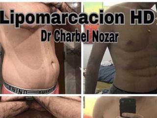 Marcación abdominal 