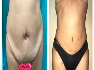 Abdominoplastía 