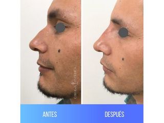 Rinoplastia