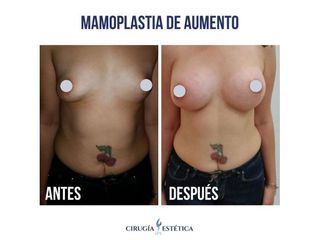 Aumento mamas