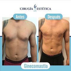 Ginecomastía