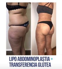 Lipo Addominoplastia + Transferencia Glútea