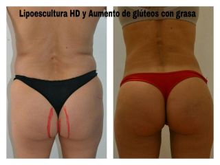 Lipoescultura HD y Aumento de Glúteos con grasa