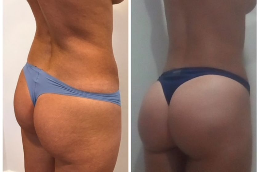Aumento glúteos antes y después - 838279