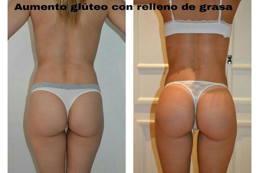 Aumento glúteos antes y después - 838281