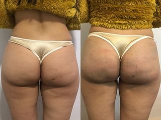 Endopeel -  Hilos rusos - Aumento de Gluteo - Aumento de Cola  Dr. Franco Gomez Medicina Estética