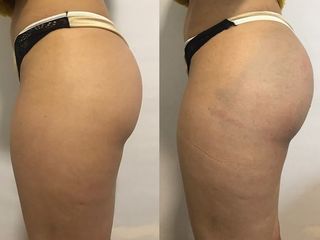 Endopeel -   Dr. Franco Gomez Medicina Estética