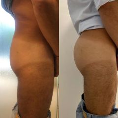 Glúteos UP - Tratamiento que dura 2 meses con 2 sesiones semanales 