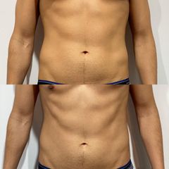 Marcación abdominal con Estimulación Magnética Neuromuscular