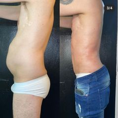Liposucción - Dr. Franco Gomez