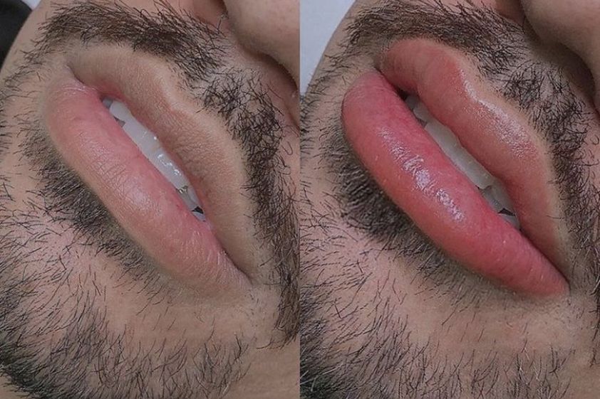Micropigmentación antes y después - 741647