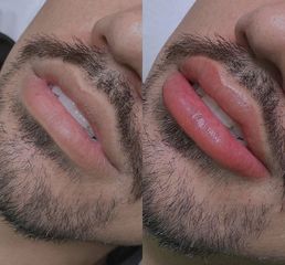 Dermopigmentacion labial - Dr. Franco Gomez