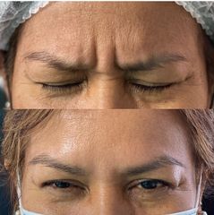 Botox - Dr. Franco Gomez