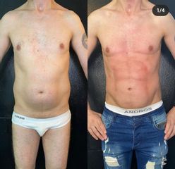 Liposucción - Dr. Franco Gomez