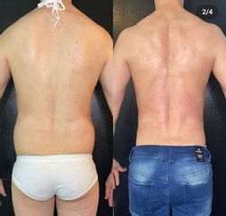 Liposucción - Dr. Franco Gomez
