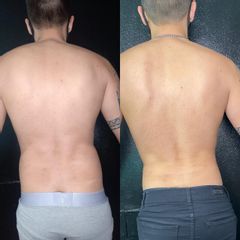 Liposucción - Dr. Franco Gomez 