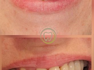 Implantes dentales antes y después - 880476