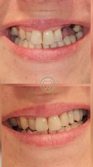 Implates dentales - Dental Digital Center