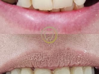 Implantes dentales antes y después - 880477