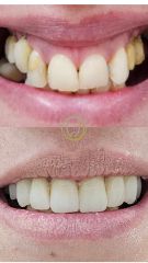 Implantes dentales - Dentarl Digital Center