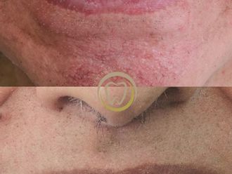 Implantes dentales antes y después - 880478