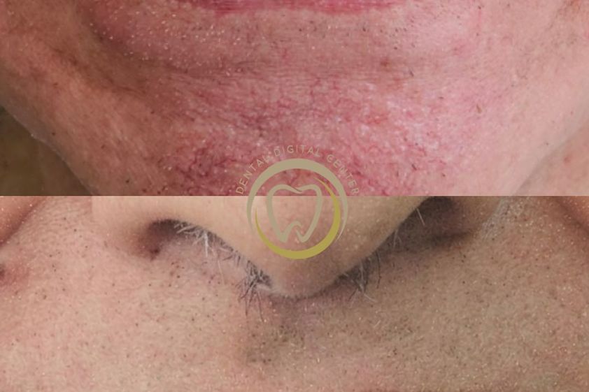 Implantes dentales antes y después - 880478