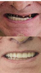 Implantes Dentales - Dental Digital Center
