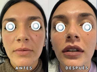 Relleno de labios antes y después - 872573