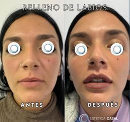 Relleno de Labios - Estetica Casal