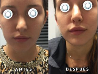 Relleno de labios antes y después - 872574