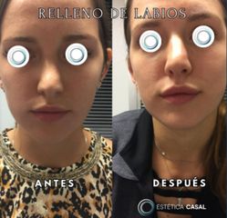 Relleno de Labios - Estetica Casal