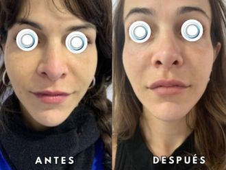 Relleno de labios antes y después - 872575