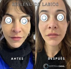 Relleno de Labios - Estetica Casal