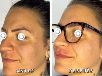 Relleno de labios antes y después - 872577