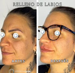 Relleno de Labios - Estetica Casal