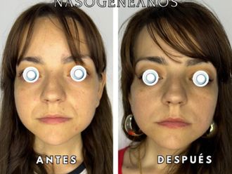 Rellenos faciales antes y después - 872578